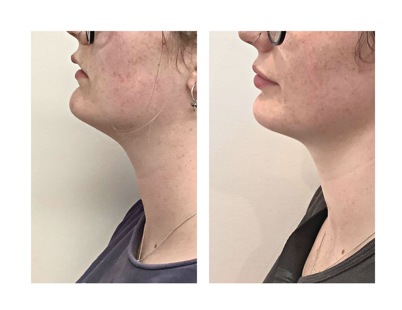 Anti-Wrinkle Lip and Chin Before and After
