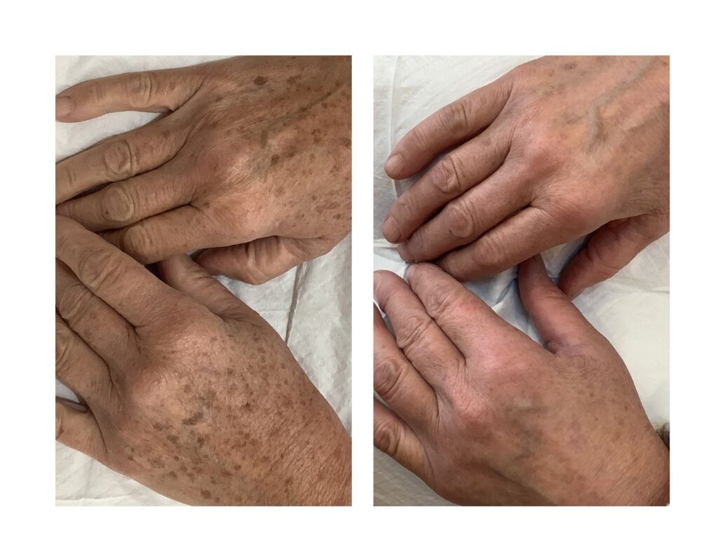 HAND REJUVENATION CASE STUDY Aescend Aesthetics